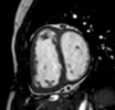 MRI of abnormal ventricular septal motion in heart diseases: a pictorial review